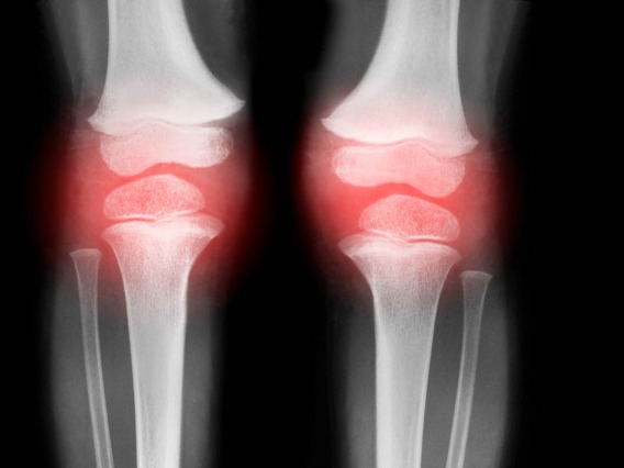 Arthritis Center Awarded $3.4M to Study Knee Deterioration
