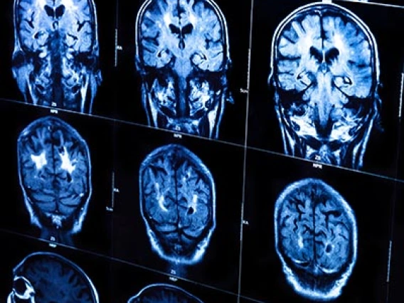 UArizona Researcher Awarded $3.4M to Develop Personalized Treatment for Mild Cognitive Impairment