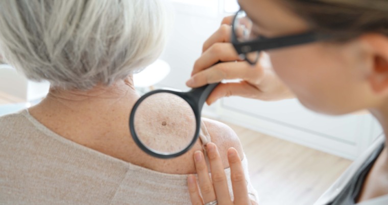 Dermatologist inspect a mole with magnifying glass 
